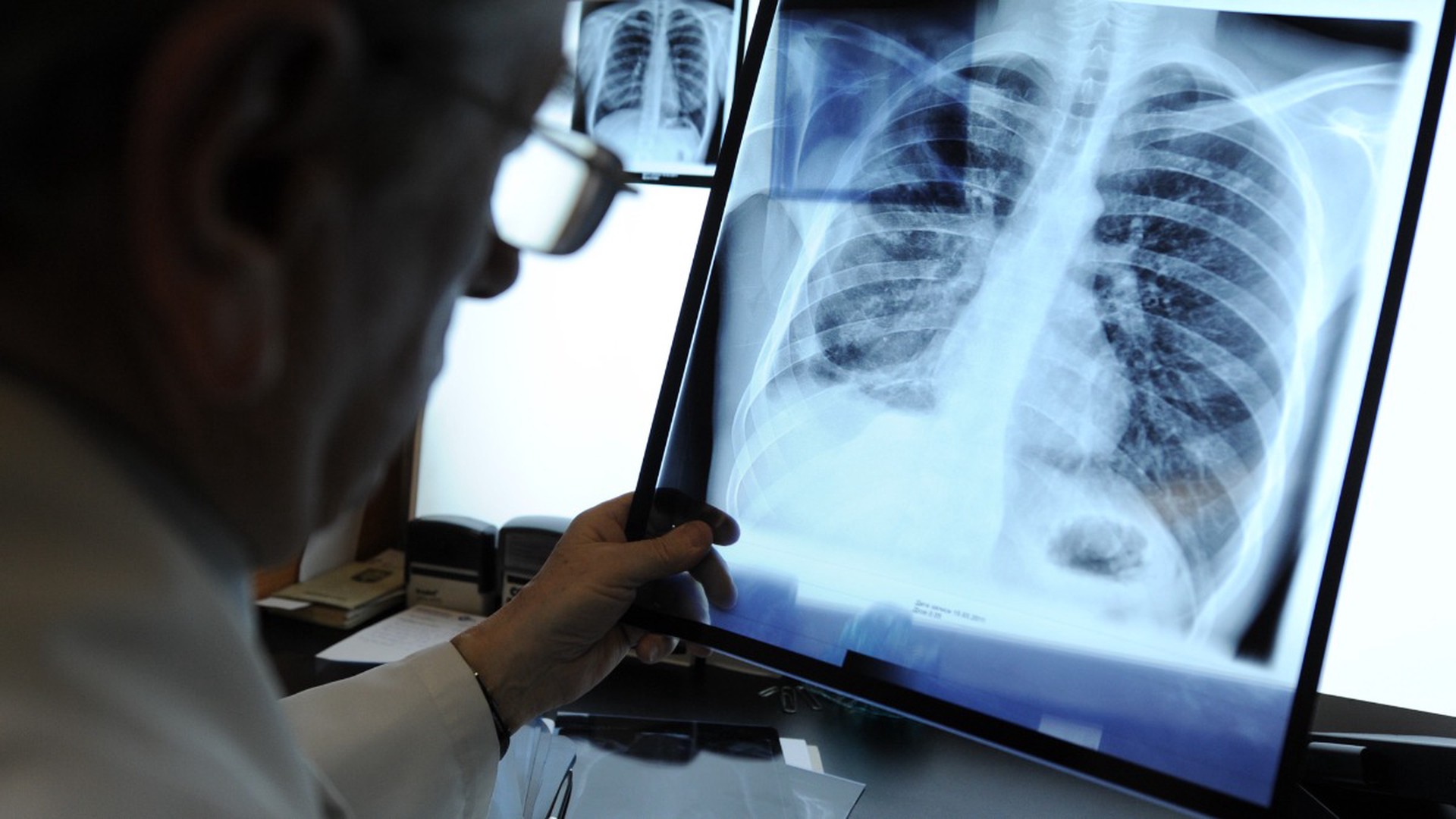 В Минздраве назвали регионы с самой высокой заболеваемостью туберкулёзом