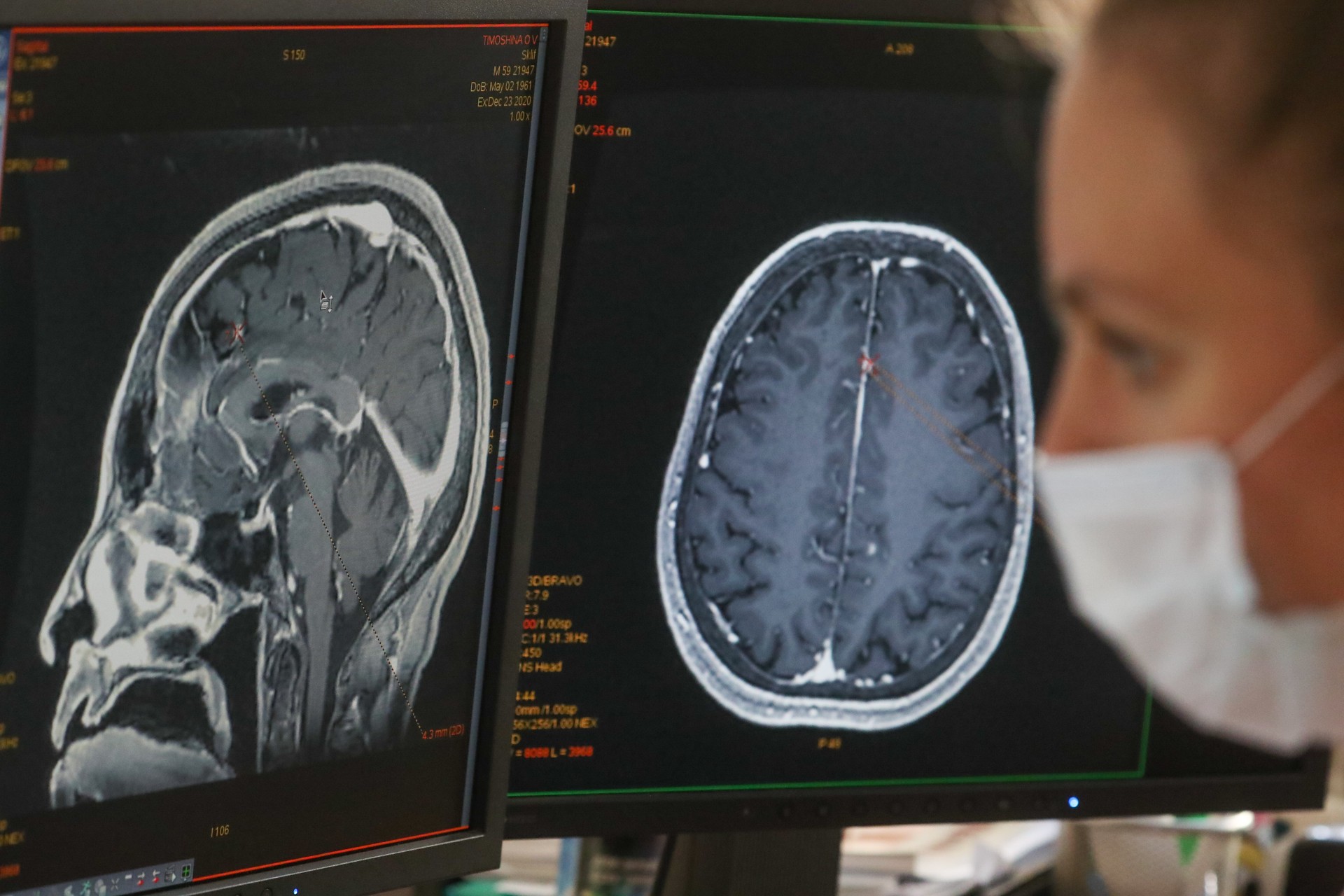Онколог рассказал об опасностях опухоли головного мозга, которая была у Анастасии Заворотнюк