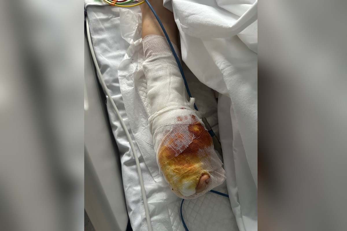 «Стойкий. Держится»: у пострадавшего при взрыве в Красногорске мальчика сохраняется болевой синдром