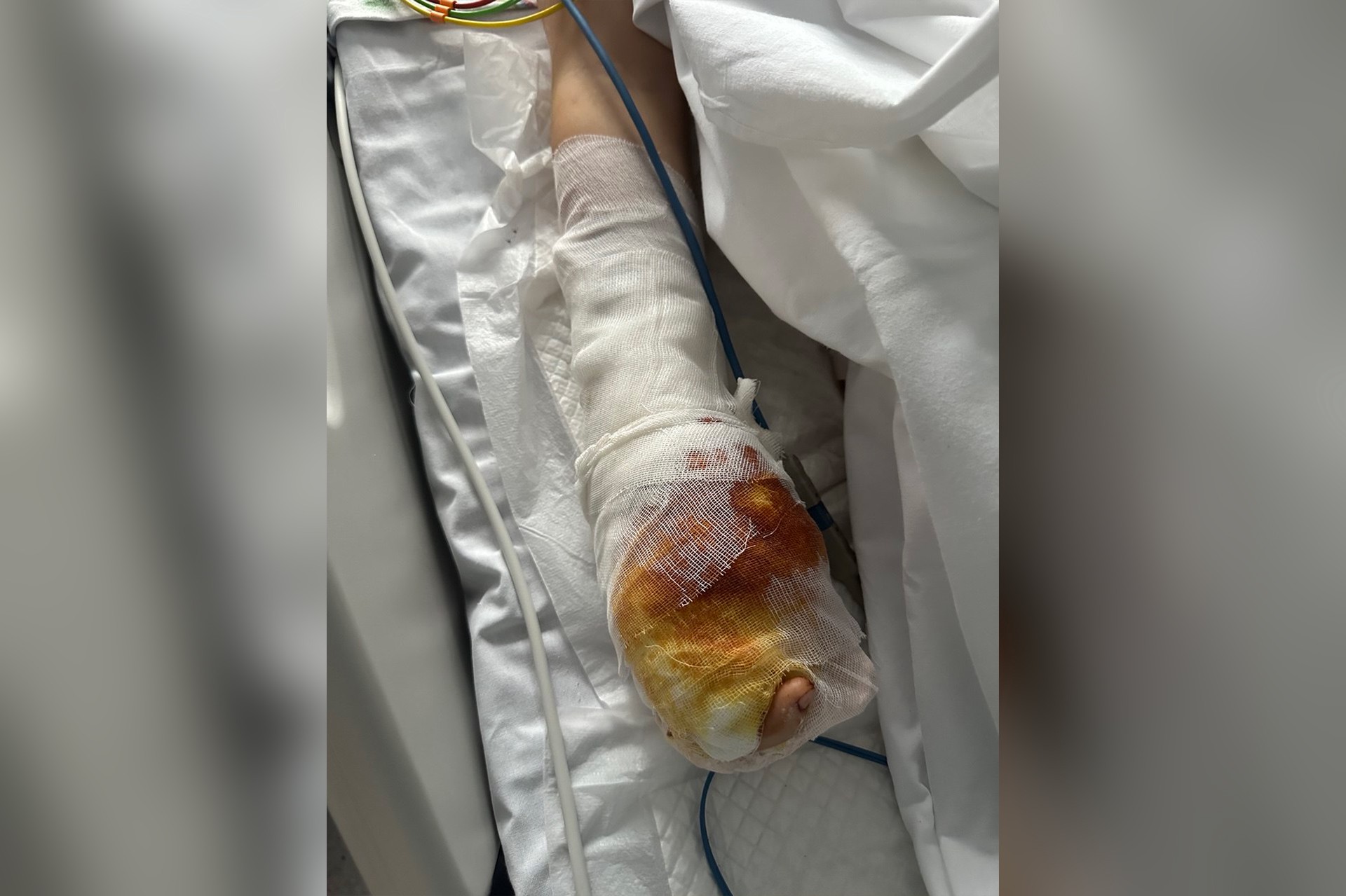 «Стойкий. Держится»: у пострадавшего при взрыве в Красногорске мальчика сохраняется болевой синдром