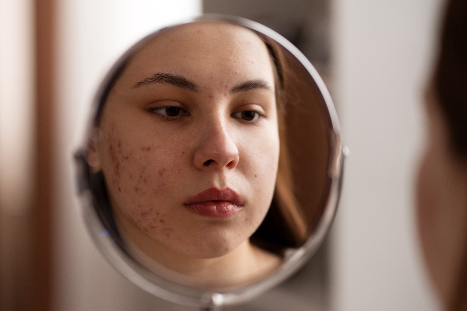 Названа настоящая причина появления угревой сыпи