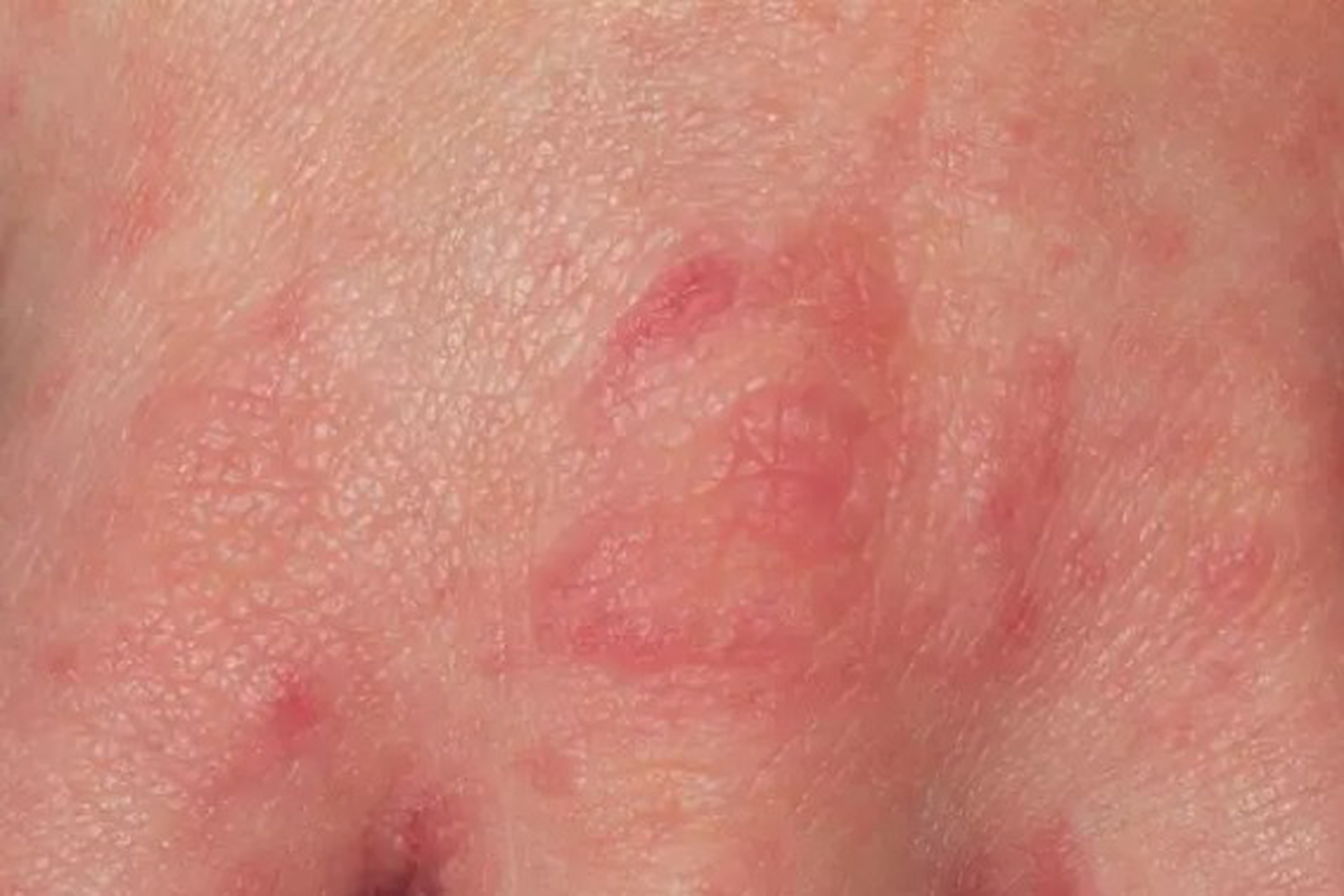 Вспышка средневековой кожной инфекции произошла в Великобритании