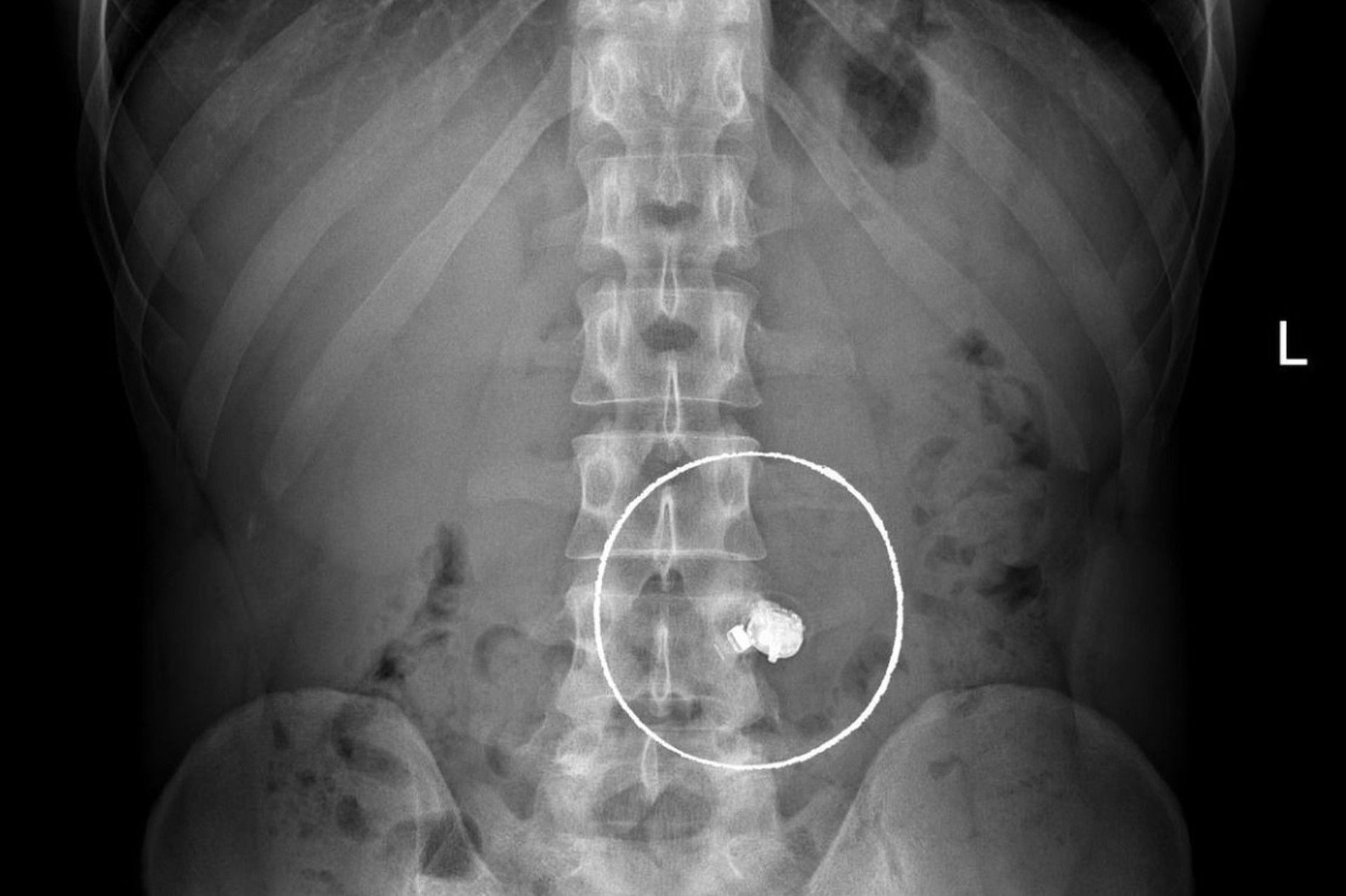 Гвозди, наушники и цепочки доставали из пациентов врачи «Склифа» в 2025 году