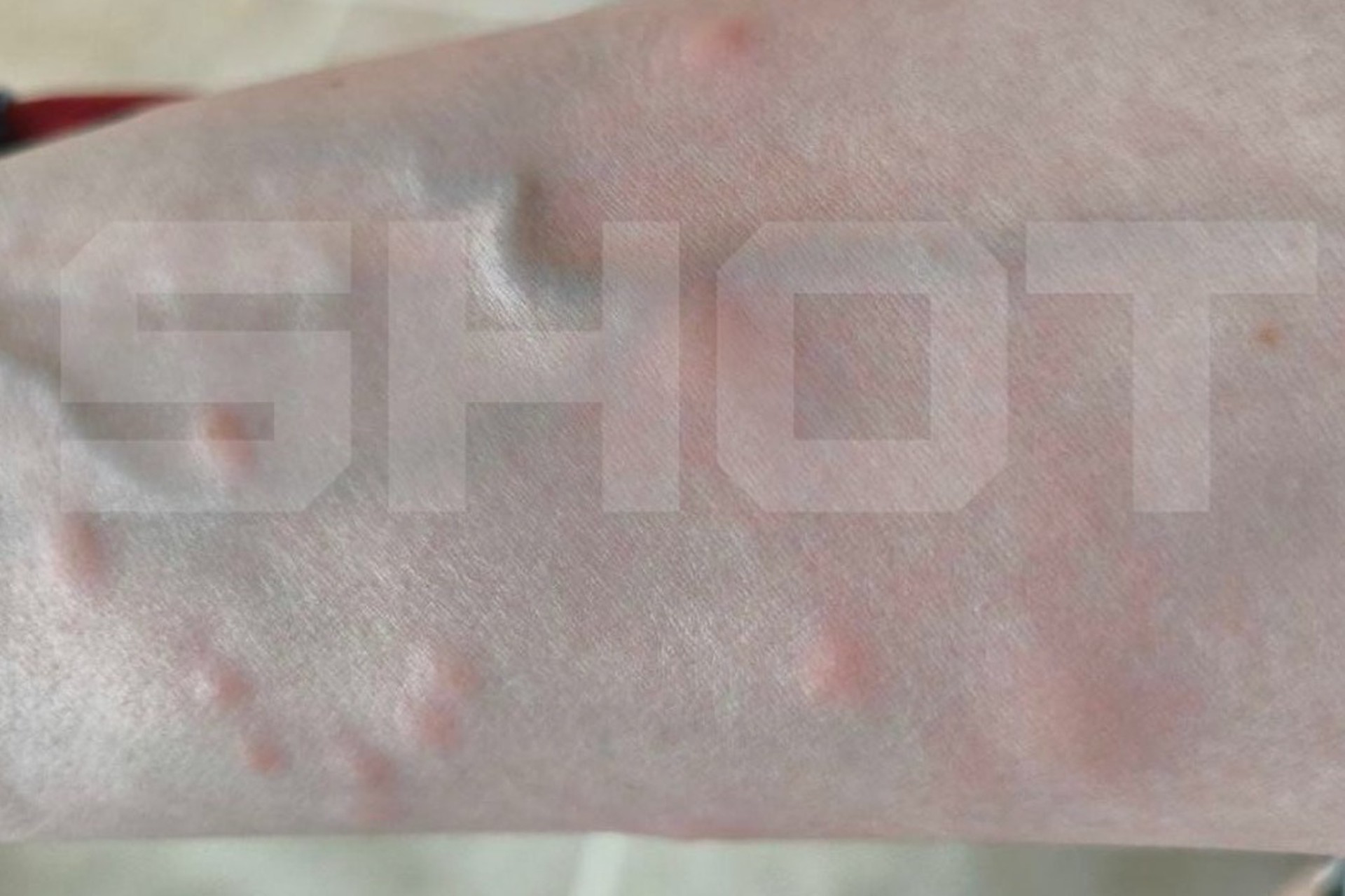 Российских туристов атаковали клопы в элитных отелях за границей