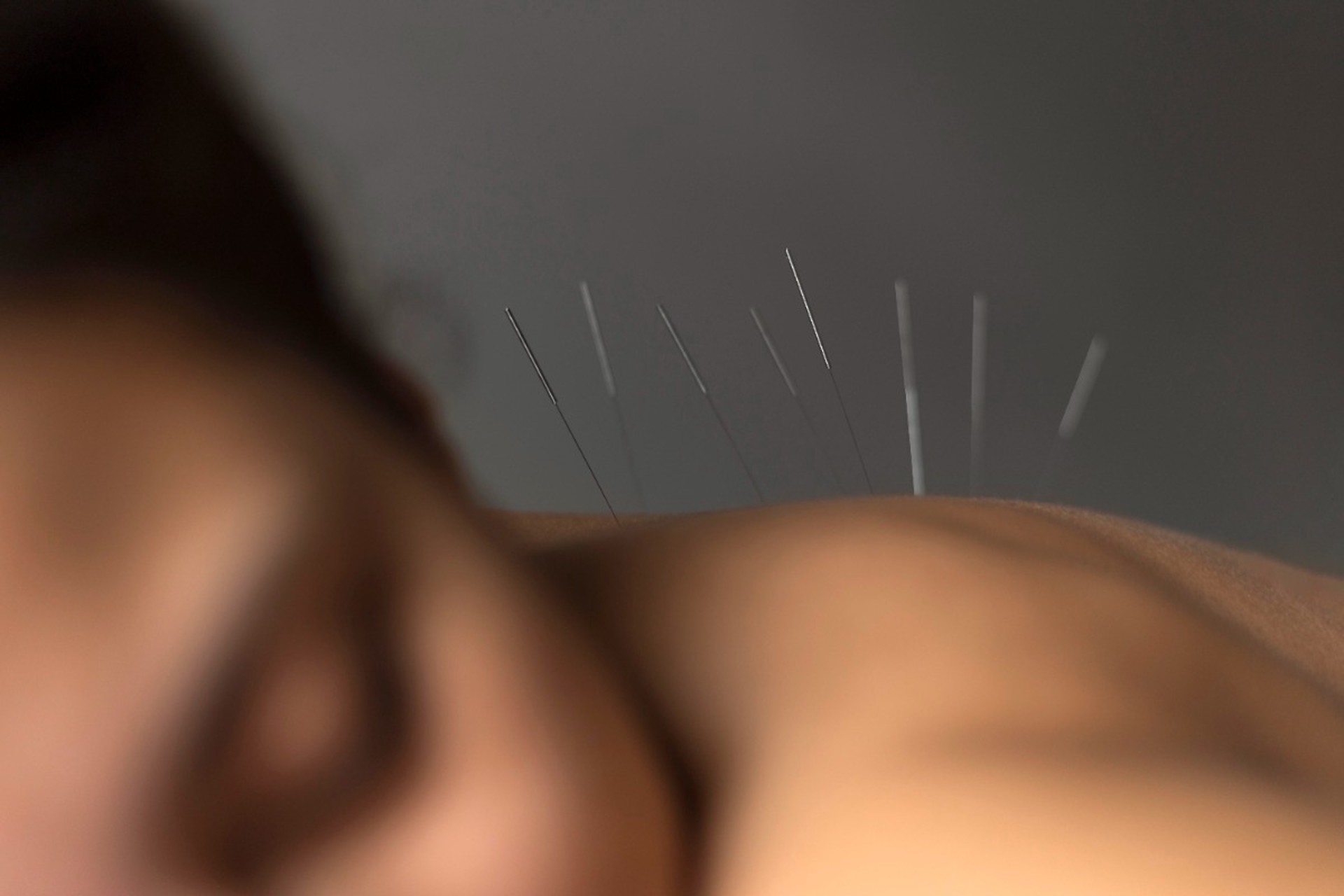 Главный миф иглоукалывания разоблачил судмедэксперт