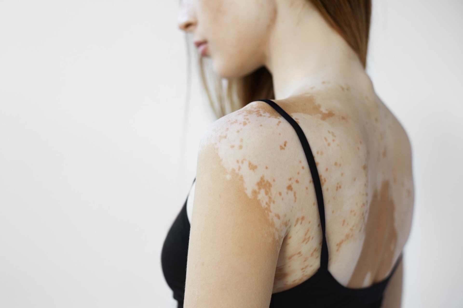 Врач предупредил об опасности самолечения витилиго